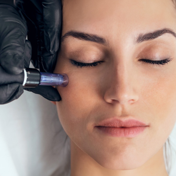 Microneedling